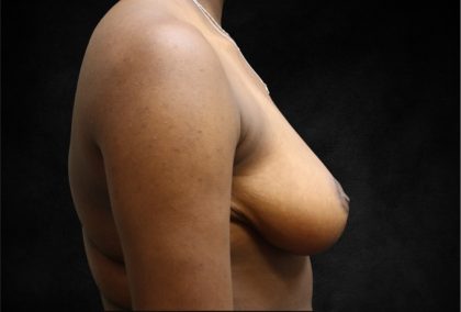 Breast Reduction Before & After Patient #13027