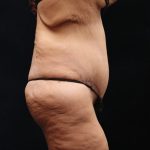 Lower Body Lift Before & After Patient #13044