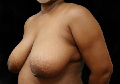 Breast Asymmetry Before & After Patient #12338