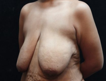 Breast Reduction Before & After Patient #12539