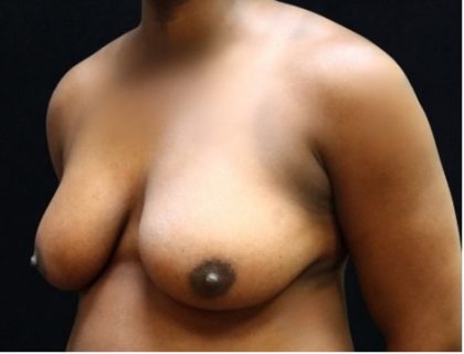Breast Reduction Before & After Patient #12544