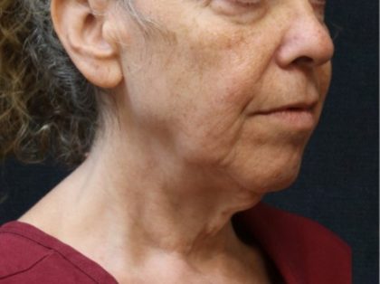 Chin Augmentation Before & After Patient #12904