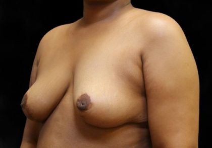 Breast Reduction Before & After Patient #12534