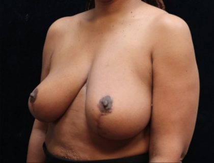 Breast Lift Before & After Patient #12724