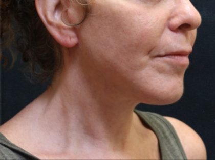 Chin Augmentation Before & After Patient #12904
