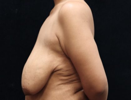 Breast Reduction Before & After Patient #12539
