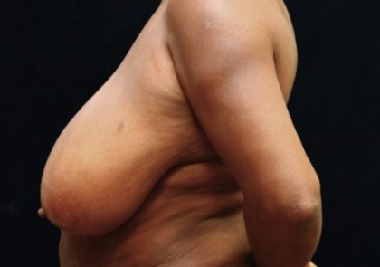 Breast Reduction Before & After Patient #12542