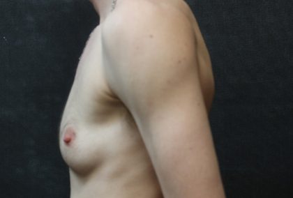 Breast Reduction Before & After Patient #12545