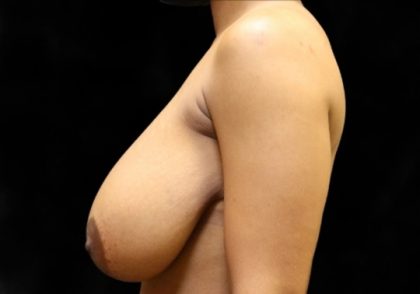 Breast Lift Before & After Patient #12402