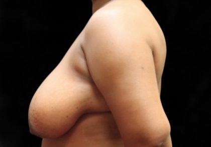 Breast Lift Before & After Patient #12406