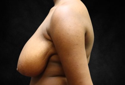 Breast Reduction Before & After Patient #13027